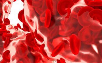 Rare medical conditions, myelodysplastic syndrome (MDS), MDS signs and symptoms, healthcare news,