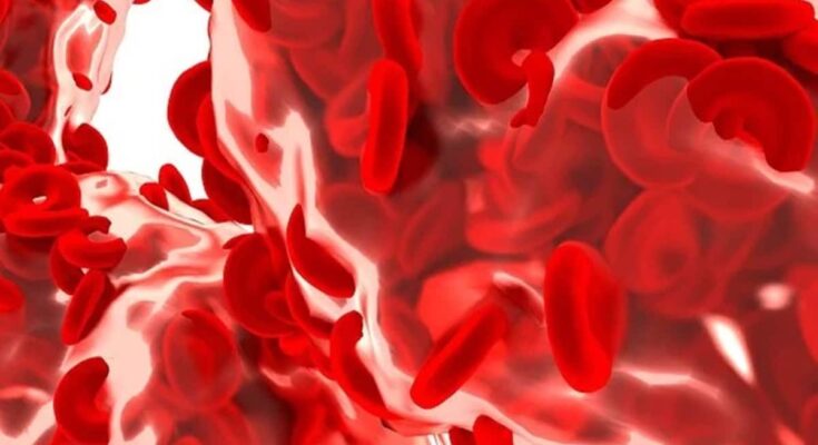Rare medical conditions, myelodysplastic syndrome (MDS), MDS signs and symptoms, healthcare news,