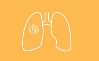 El seguimiento de 2 años respalda la monoterapia con adagracib en el NSCLC con mutación KRAS G12C