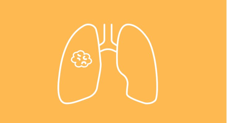 El seguimiento de 2 años respalda la monoterapia con adagracib en el NSCLC con mutación KRAS G12C