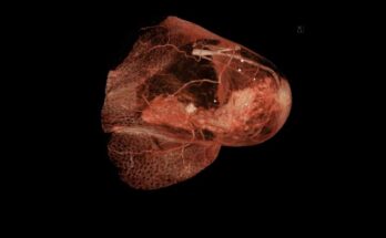 Investigadores del cáncer: 'una mastectomía innecesaria por cada caso real de cáncer'