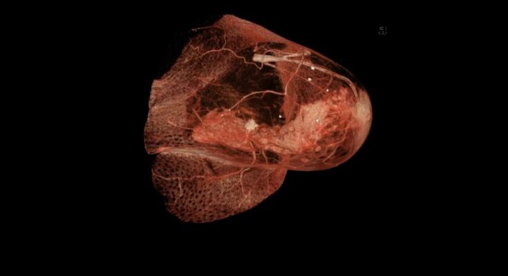 Investigadores del cáncer: 'una mastectomía innecesaria por cada caso real de cáncer'