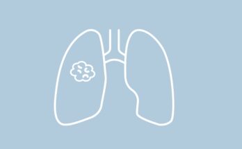 Repotrectinib demuestra respuestas intracraneales tempranas en NSCLC ROS1+ seleccionado
