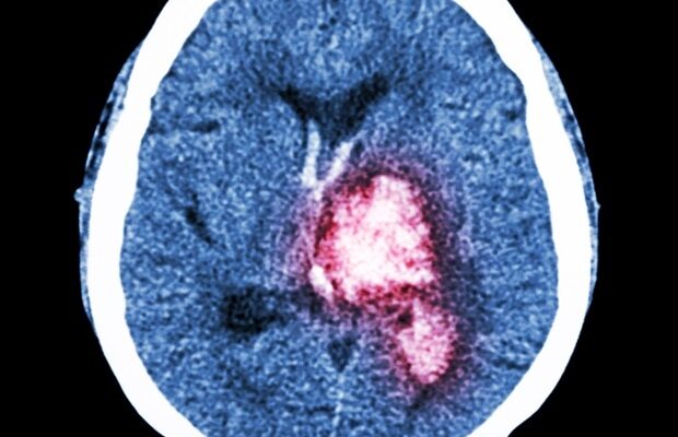 El primer estudio de su tipo revela un nuevo culpable en la formación de hemorragia cerebral