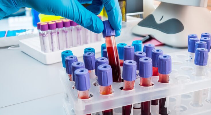 Los científicos inventan una prueba de TS para el cáncer antes de años de síntomas